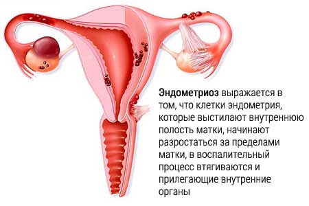 Гиперплазия эндометрия